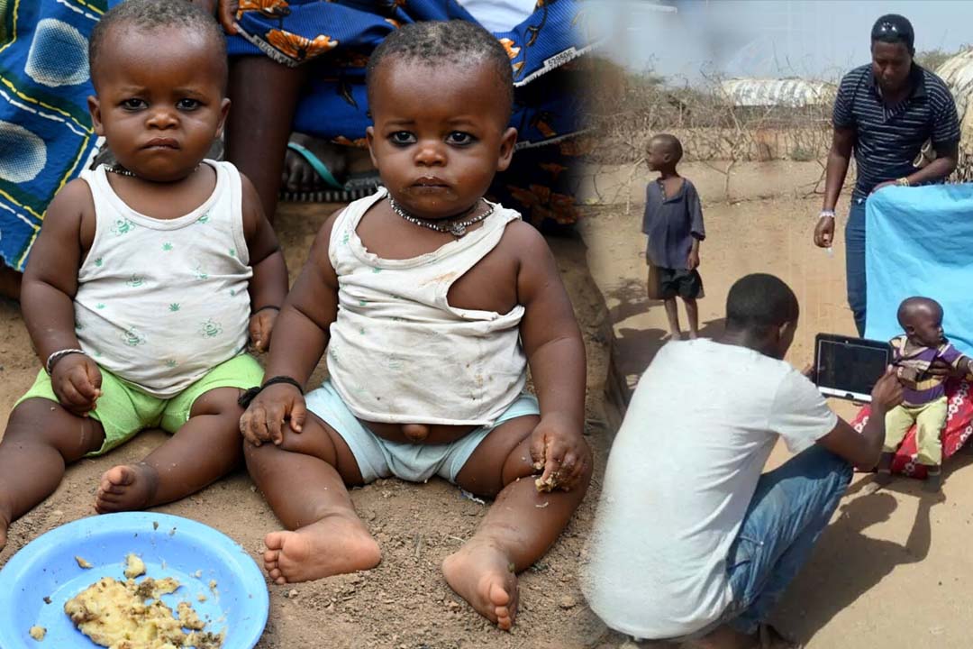 Malnutrition : ఫోటోతోనే పిల్లల ఆరోగ్య పరిస్థితి చెప్పే టెక్నాలజీ