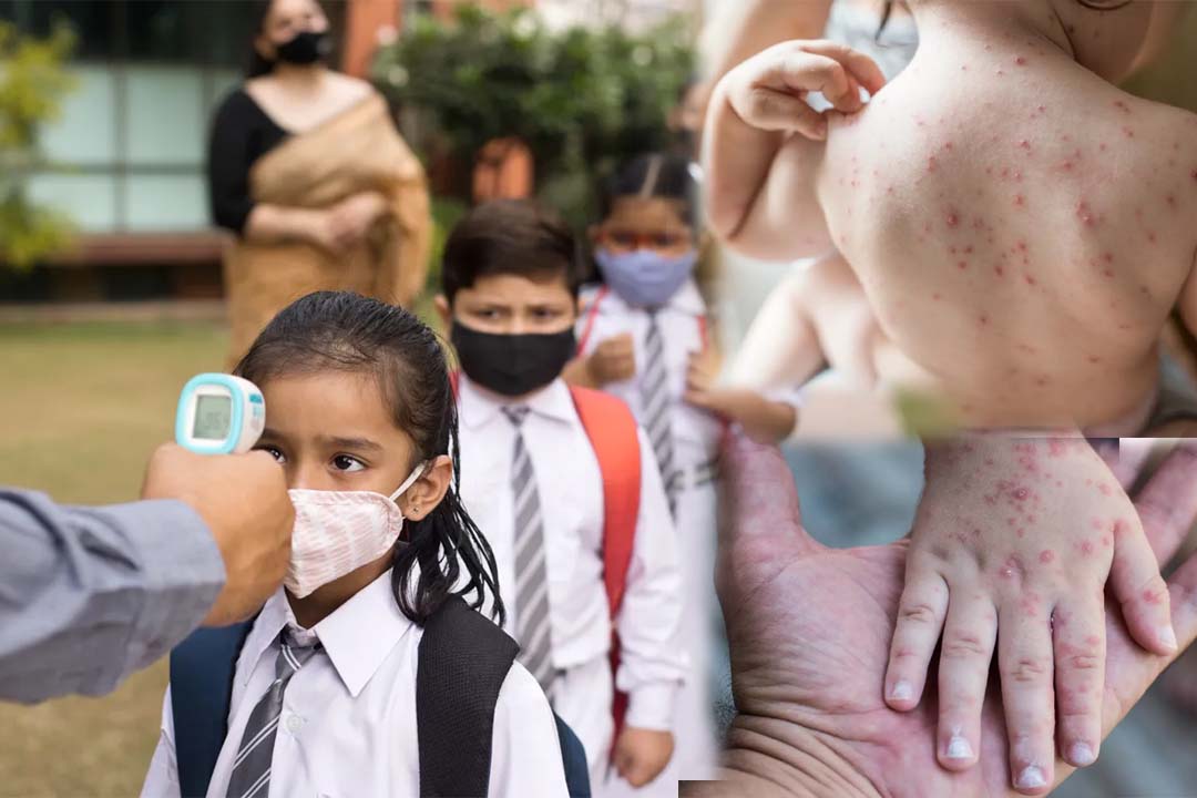 Tomato flu : టొమాటో ఫ్లూ ఏమిటి? లక్షణాలు, చికిత్స, జాగ్రత్తలు